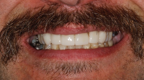 Closeup of smile after dental treatment