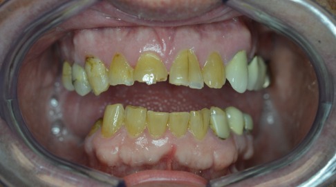 Extensive dental decay and damage before dental restoration