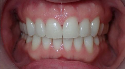 Healthy flawless smile after dental treatment