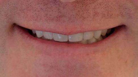 Imperfect smile before dental treatment