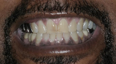 Discolored top front teeth