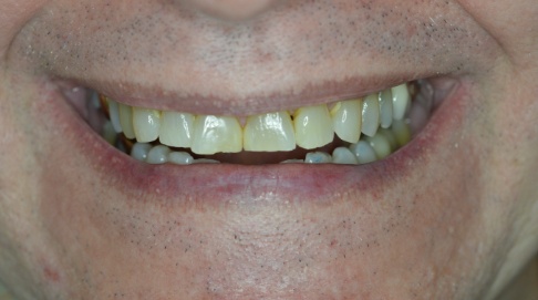Yellowed and damaged smile before dental treatment