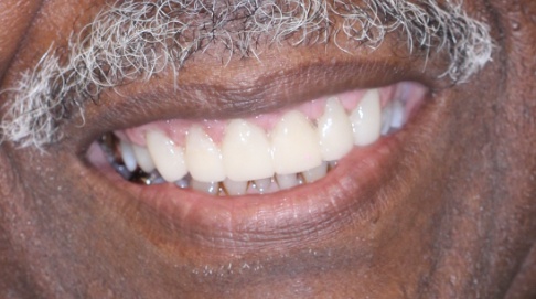 Brilliant white and healthy smile after dental care