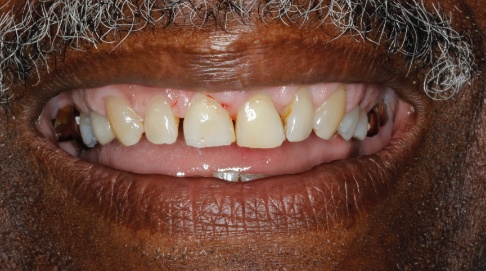 Worn and severely decayed smile before dental care
