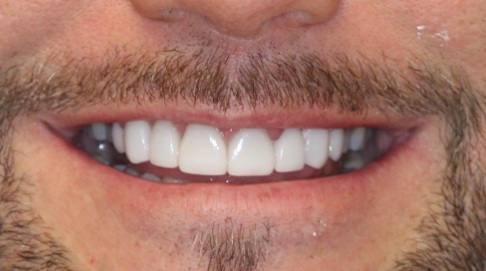 Beautiful healthy smile after cosmetic dentistry