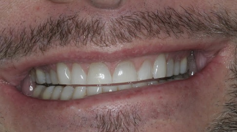Short worn teeth before cosmetic dentistry