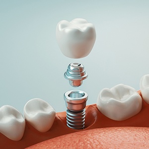 dental implant in Conroe