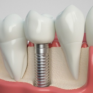 Model showing a dental implant in Conroe during osseointegration
