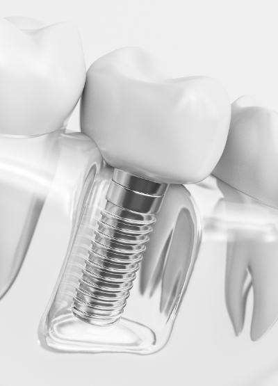 Animated smile with dental implant supported dental crown