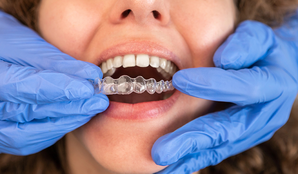 Dentist in gloves applying invisible aligner on female patient teeth at modern clinic. Orthodontic removable straighteners in dentist office. Dental treatment concept.