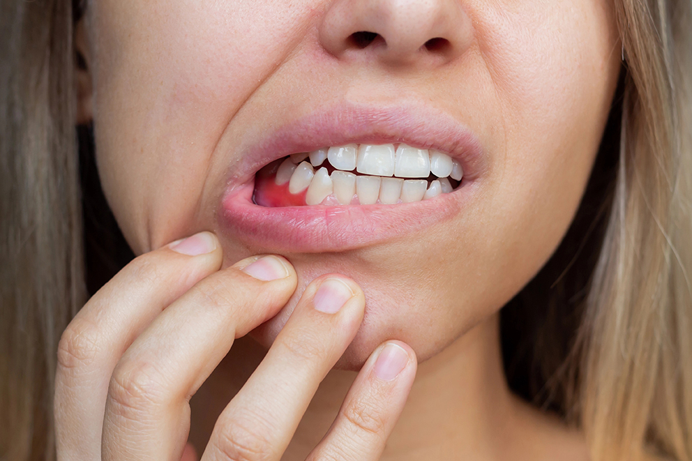 bleeding-gums