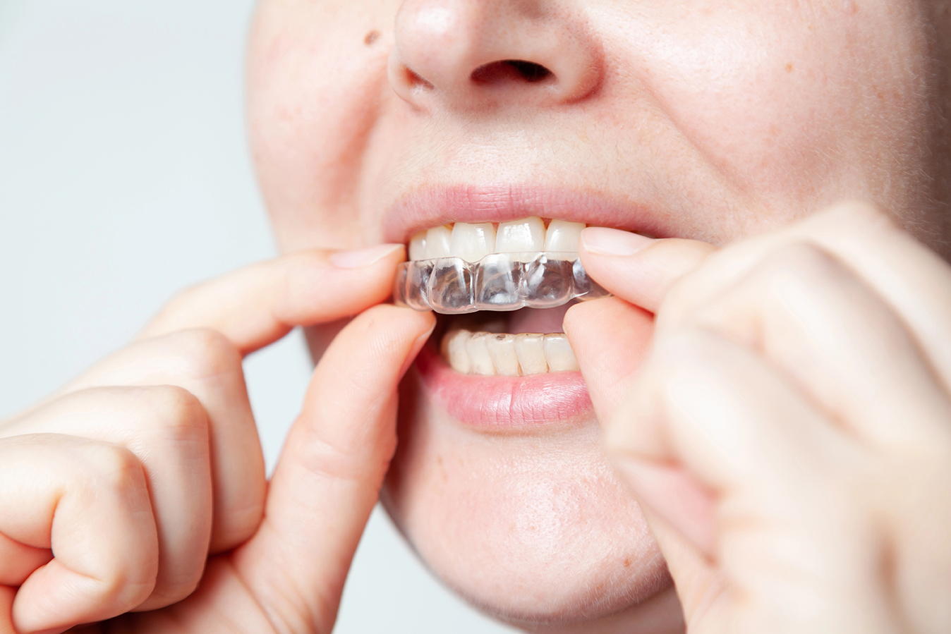 A woman carefully puts a plastic retention cap on her upper teeth with her fingers. Woman face and mouth close-up on a gray background